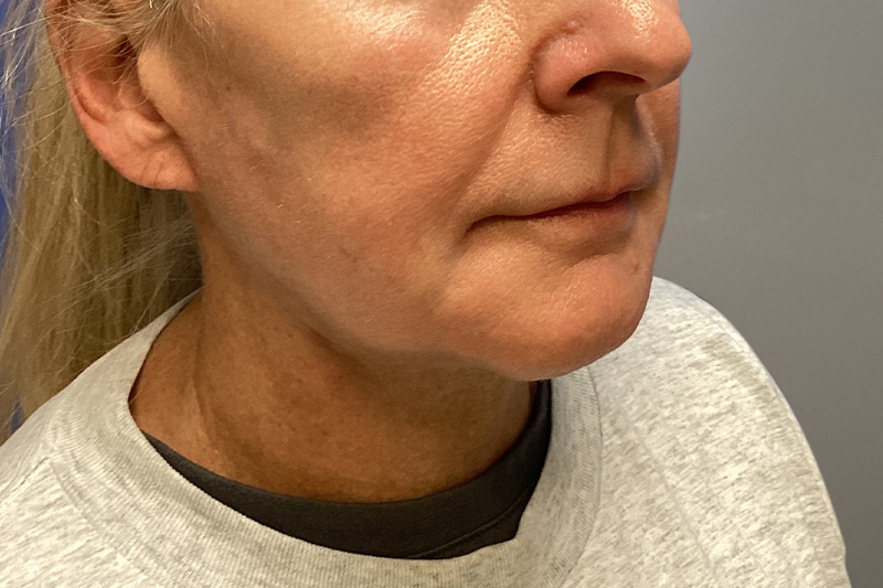 NECK LIFT Before & After Gallery - Patient 387399 - Image 8