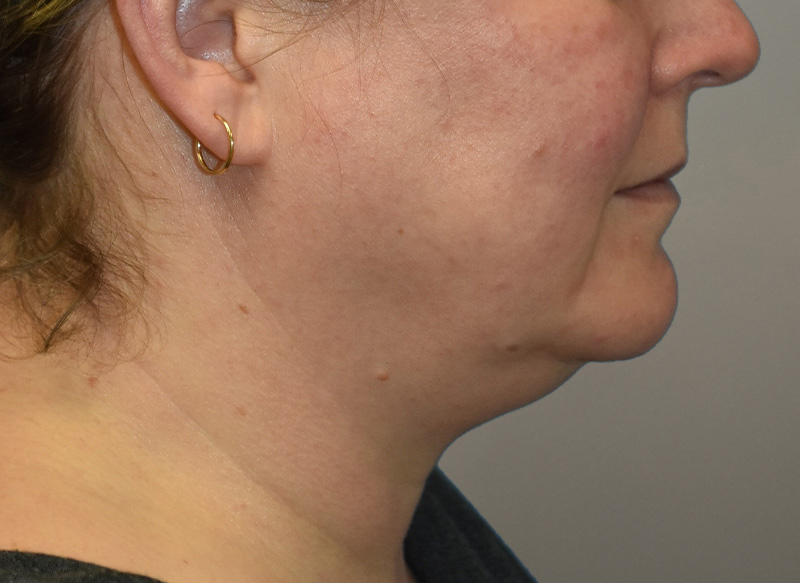 NECK LIFT Before & After Gallery - Patient 619010 - Image 1