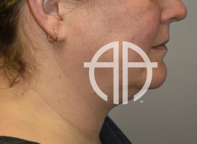 NECK LIFT Before & After Gallery - Patient 619010 - Image 1