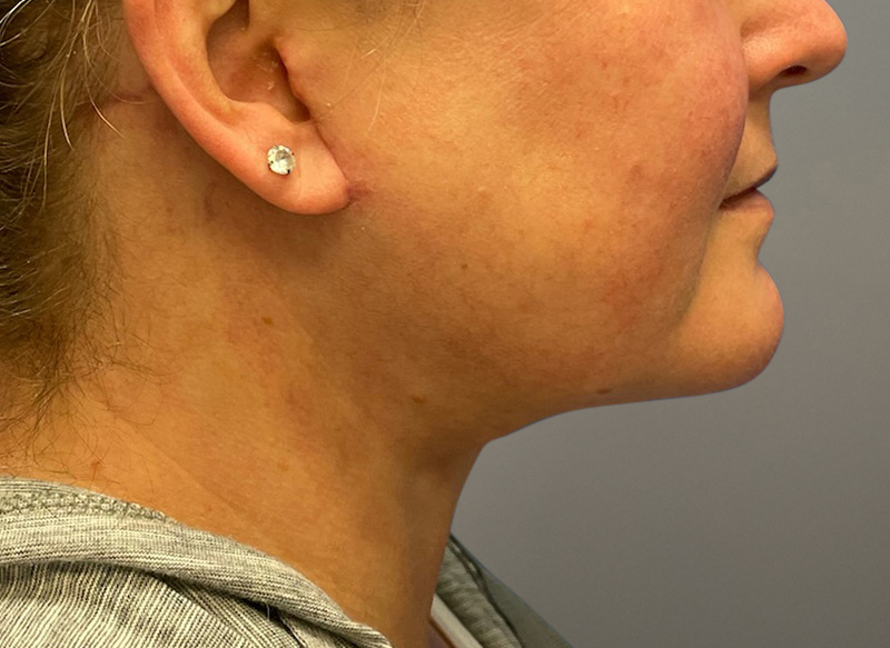 NECK LIFT Before & After Gallery - Patient 619010 - Image 2