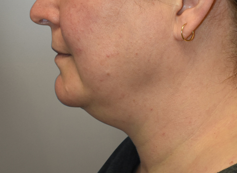 NECK LIFT Before & After Gallery - Patient 619010 - Image 3