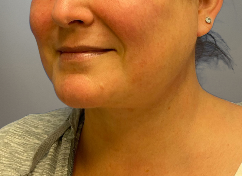 NECK LIFT Before & After Gallery - Patient 619010 - Image 6