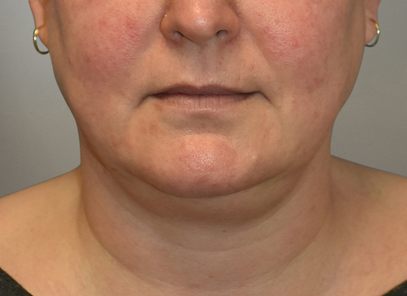 NECK LIFT Before & After Gallery - Patient 619010 - Image 9