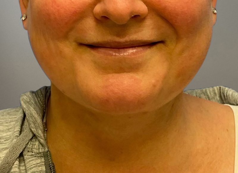 NECK LIFT Before & After Gallery - Patient 619010 - Image 10