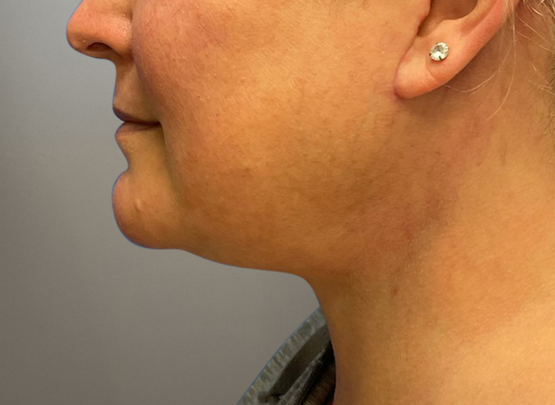 NECK LIFT Before & After Gallery - Patient 619010 - Image 4