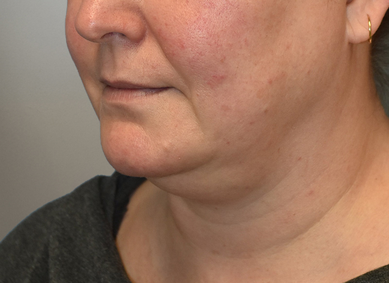 NECK LIFT Before & After Gallery - Patient 619010 - Image 5