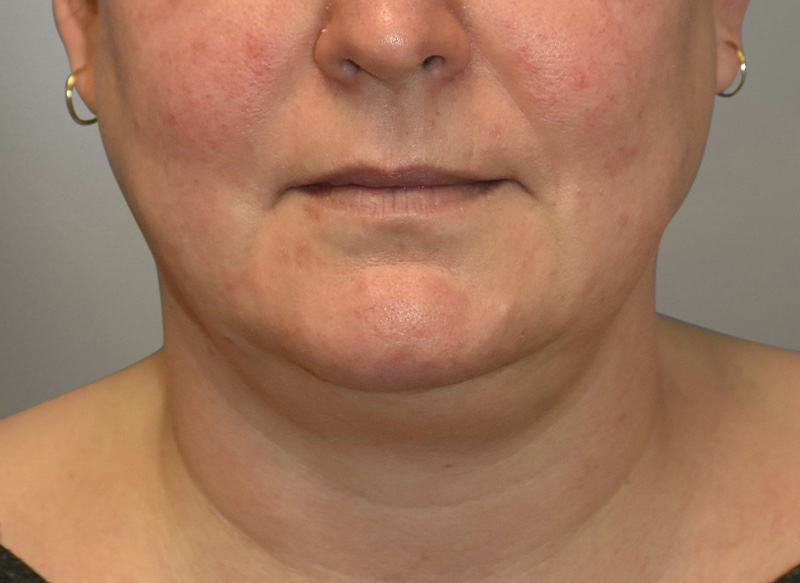 NECK LIFT Before & After Gallery - Patient 619010 - Image 7