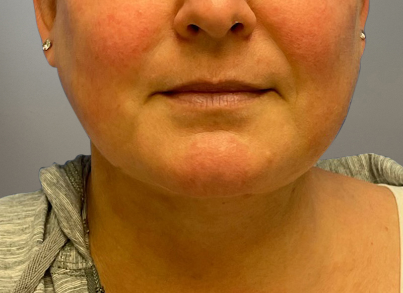 NECK LIFT Before & After Gallery - Patient 619010 - Image 8
