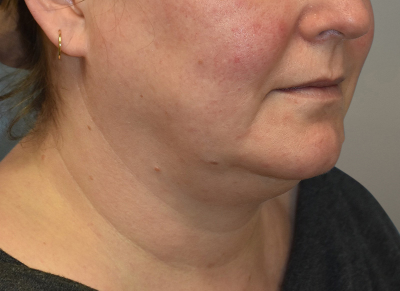 NECK LIFT Before & After Gallery - Patient 619010 - Image 11