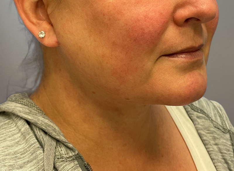 NECK LIFT Before & After Gallery - Patient 619010 - Image 12