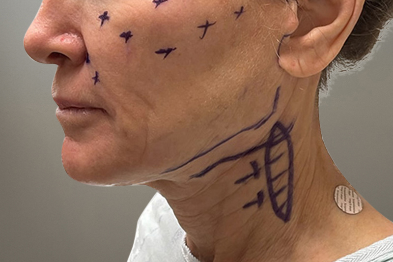 NECK LIFT Before & After Gallery - Patient 633592 - Image 1