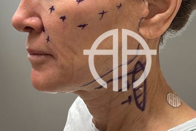 NECK LIFT Before & After Gallery - Patient 633592 - Image 1
