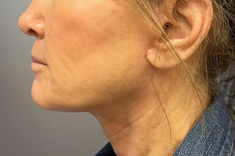 NECK LIFT Before & After Gallery - Patient 633592 - Image 2