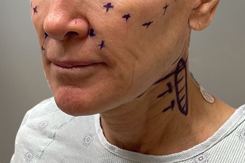 NECK LIFT Before & After Gallery - Patient 633592 - Image 3