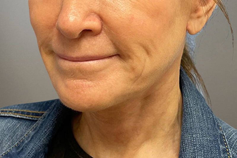 NECK LIFT Before & After Gallery - Patient 633592 - Image 4