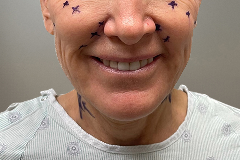 NECK LIFT Before & After Gallery - Patient 633592 - Image 5