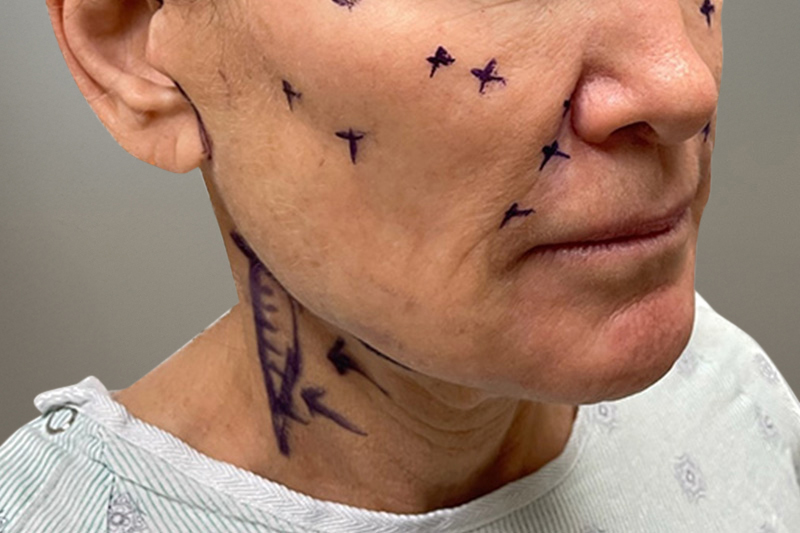NECK LIFT Before & After Gallery - Patient 633592 - Image 7