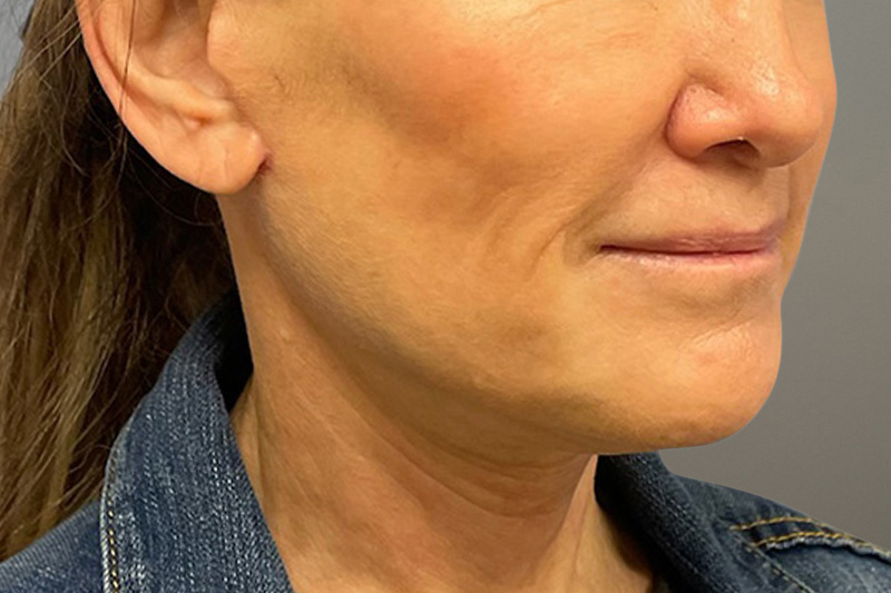 NECK LIFT Before & After Gallery - Patient 633592 - Image 8