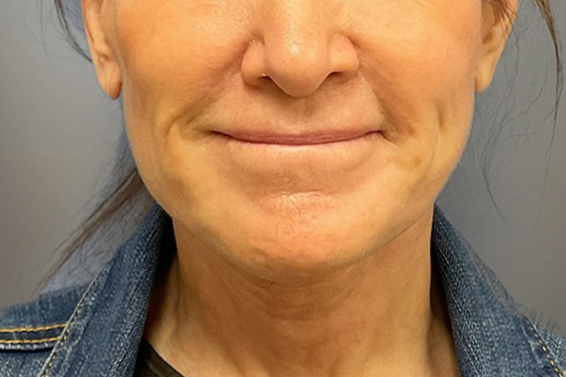 NECK LIFT Before & After Gallery - Patient 633592 - Image 6