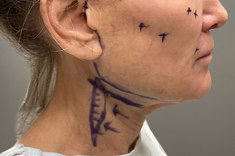 NECK LIFT Before & After Gallery - Patient 633592 - Image 9