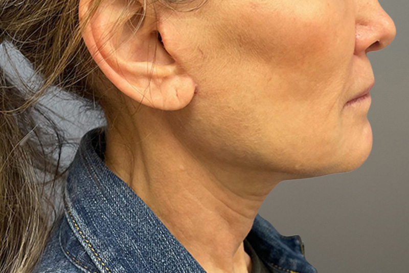 NECK LIFT Before & After Gallery - Patient 633592 - Image 10