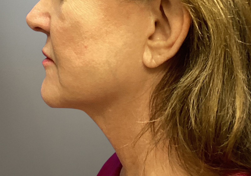 NECK LIFT Before & After Gallery - Patient 789901 - Image 1