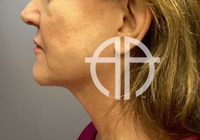 NECK LIFT Before & After Gallery - Patient 789901 - Image 1