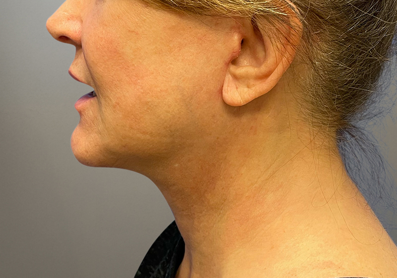 NECK LIFT Before & After Gallery - Patient 789901 - Image 2