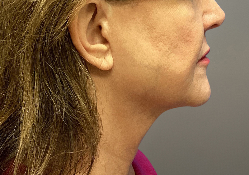 NECK LIFT Before & After Gallery - Patient 789901 - Image 3