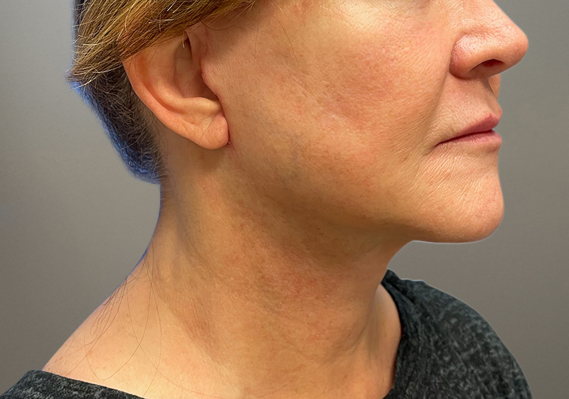 NECK LIFT Before & After Gallery - Patient 789901 - Image 8