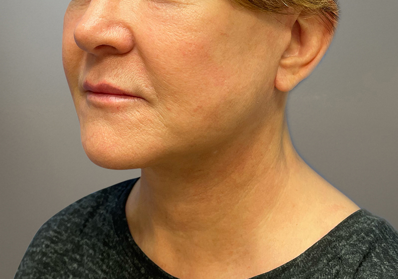 NECK LIFT Before & After Gallery - Patient 789901 - Image 10