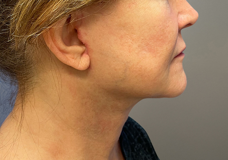 NECK LIFT Before & After Gallery - Patient 789901 - Image 4