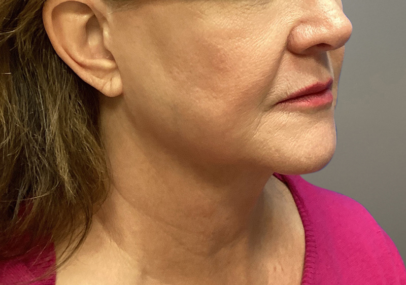 NECK LIFT Before & After Gallery - Patient 789901 - Image 7