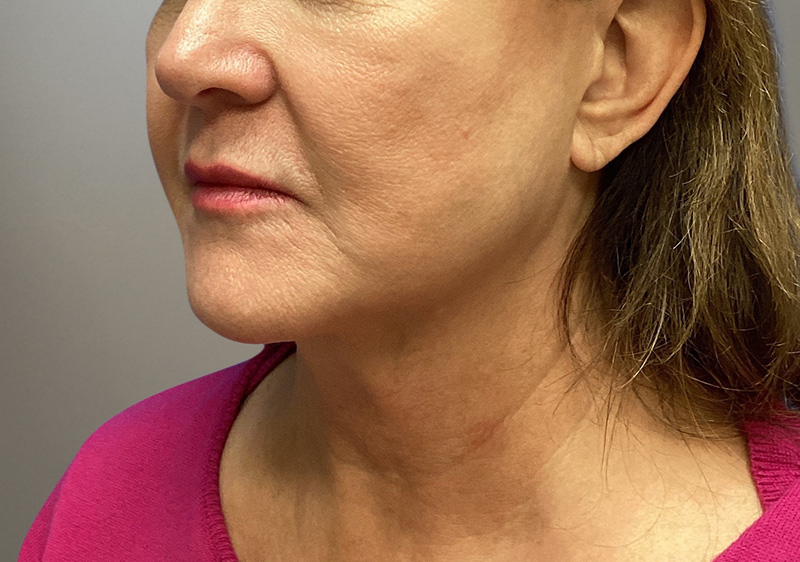 NECK LIFT Before & After Gallery - Patient 789901 - Image 9