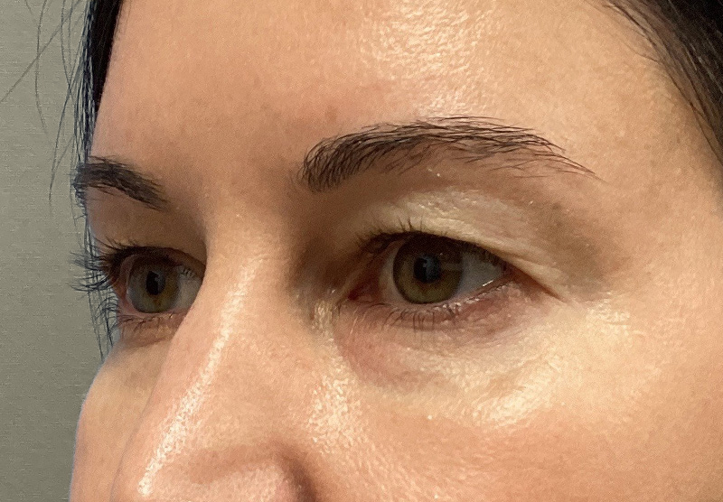 BLEPHAROPLASTY Before & After Gallery - Patient 118829 - Image 7