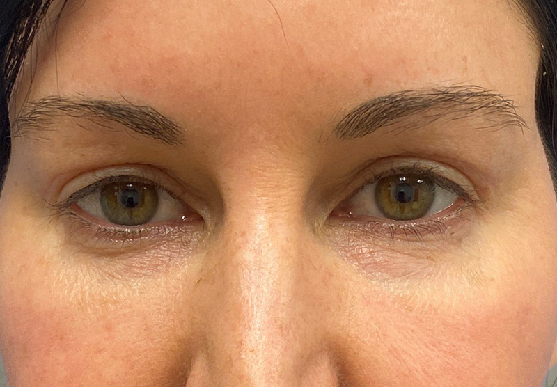 BLEPHAROPLASTY Before & After Gallery - Patient 118829 - Image 2