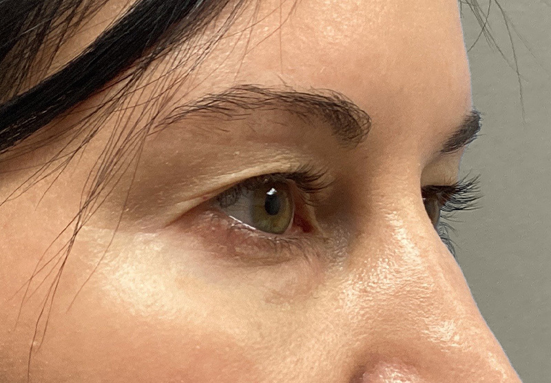 BLEPHAROPLASTY Before & After Gallery - Patient 118829 - Image 3