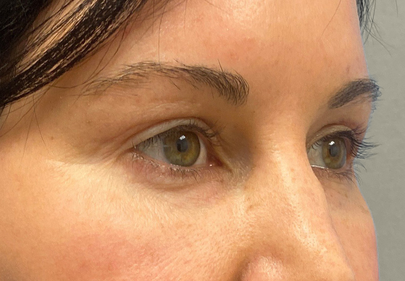 BLEPHAROPLASTY Before & After Gallery - Patient 118829 - Image 4