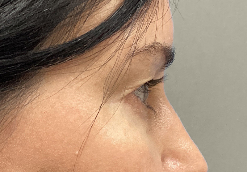 BLEPHAROPLASTY Before & After Gallery - Patient 118829 - Image 5
