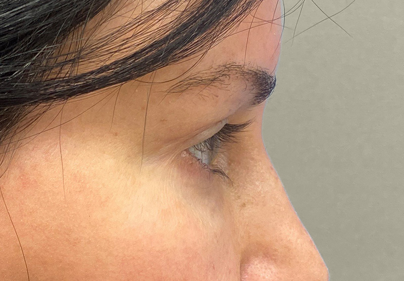 BLEPHAROPLASTY Before & After Gallery - Patient 118829 - Image 6