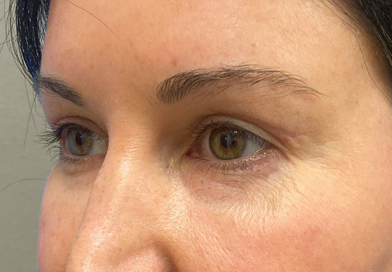 BLEPHAROPLASTY Before & After Gallery - Patient 118829 - Image 8
