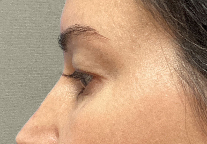 BLEPHAROPLASTY Before & After Gallery - Patient 118829 - Image 9