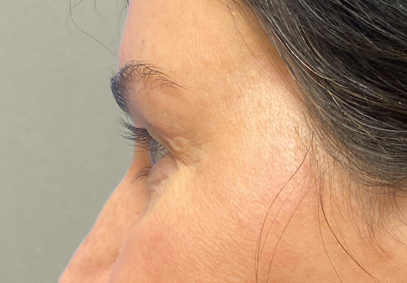 BLEPHAROPLASTY Before & After Gallery - Patient 118829 - Image 10