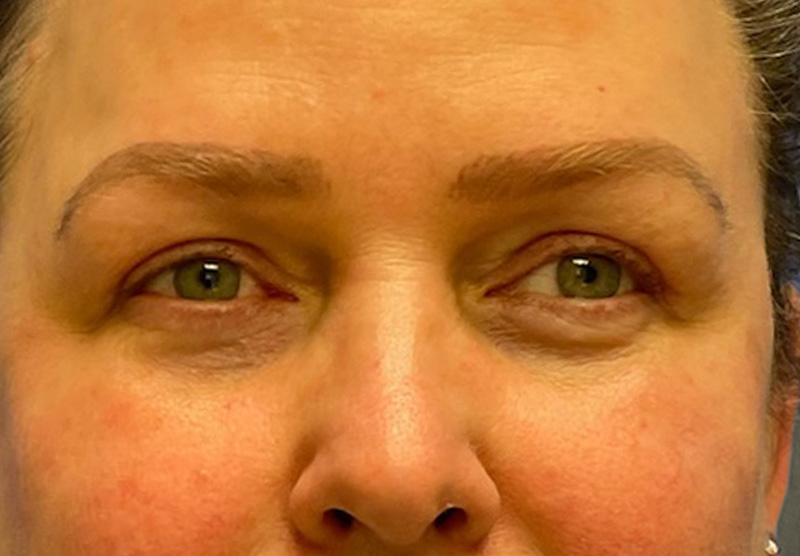 BLEPHAROPLASTY Before & After Gallery - Patient 225256 - Image 2