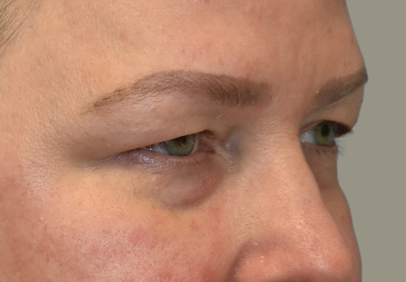 BLEPHAROPLASTY Before & After Gallery - Patient 225256 - Image 3