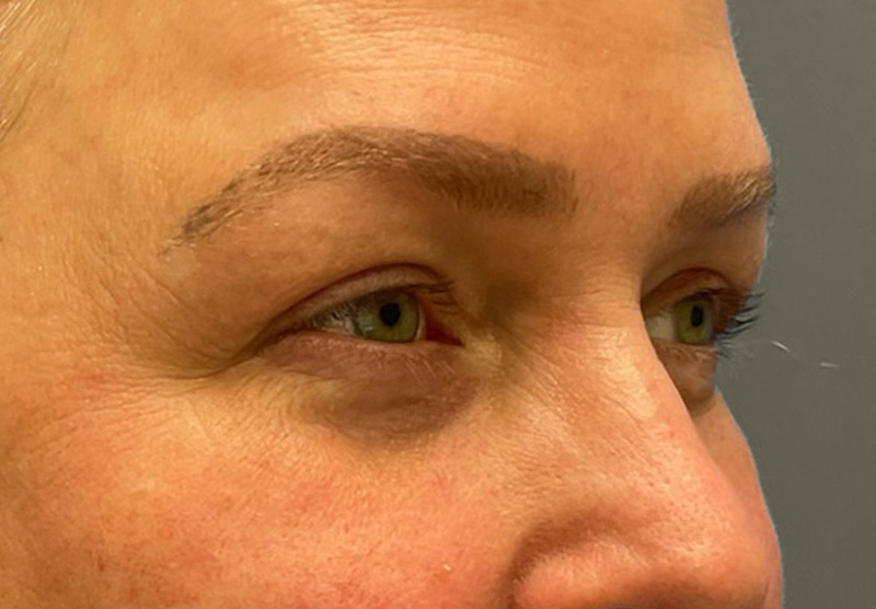 BLEPHAROPLASTY Before & After Gallery - Patient 225256 - Image 4