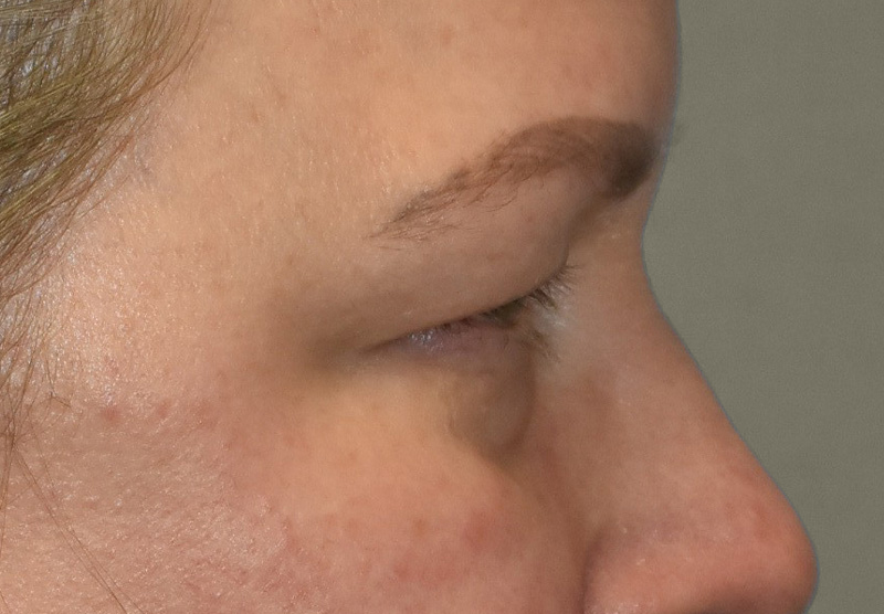 BLEPHAROPLASTY Before & After Gallery - Patient 225256 - Image 5
