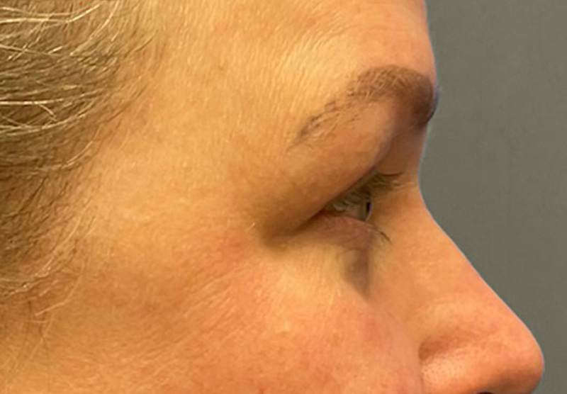 BLEPHAROPLASTY Before & After Gallery - Patient 225256 - Image 6