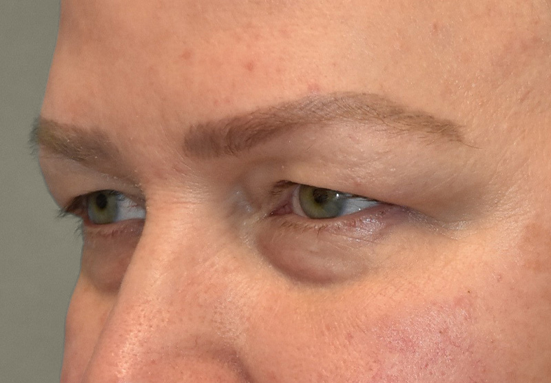 BLEPHAROPLASTY Before & After Gallery - Patient 225256 - Image 7