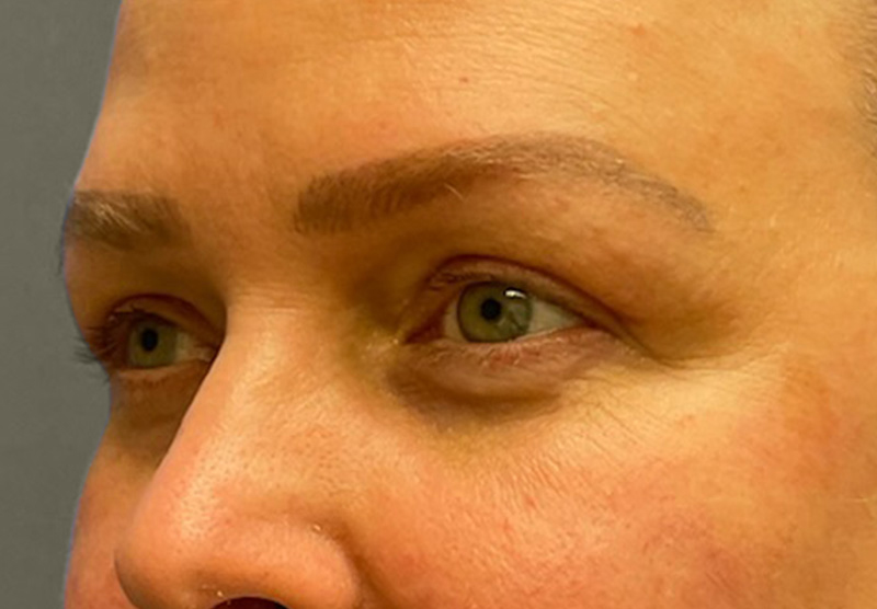 BLEPHAROPLASTY Before & After Gallery - Patient 225256 - Image 8